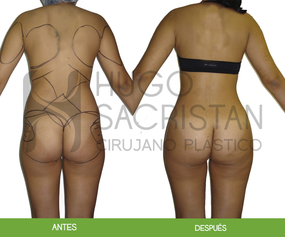Liposucción
