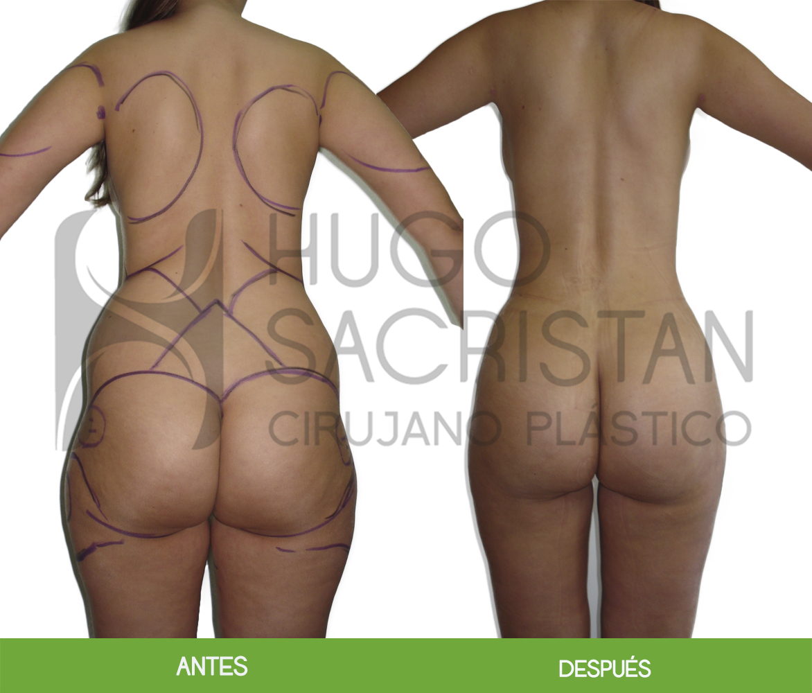 Liposucción