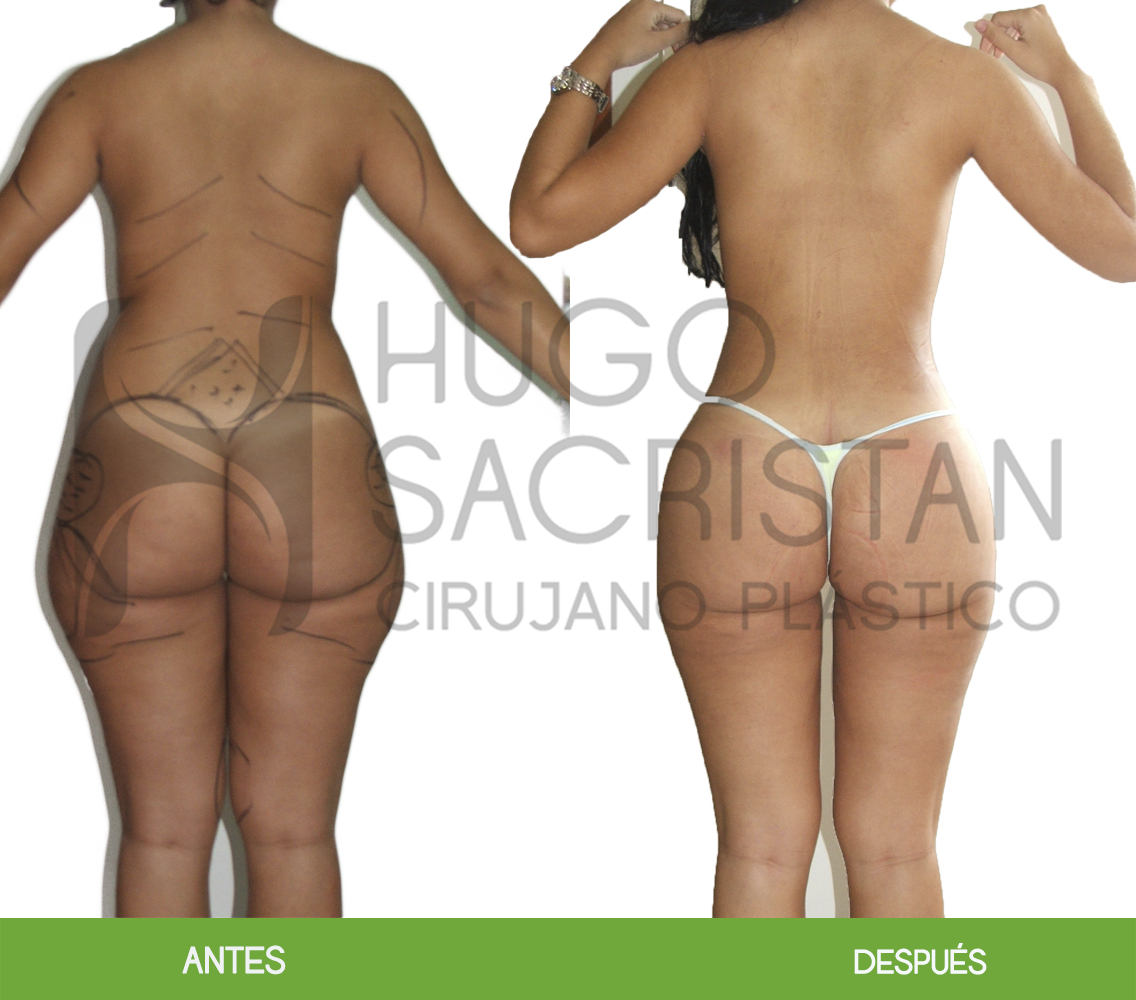Liposucción