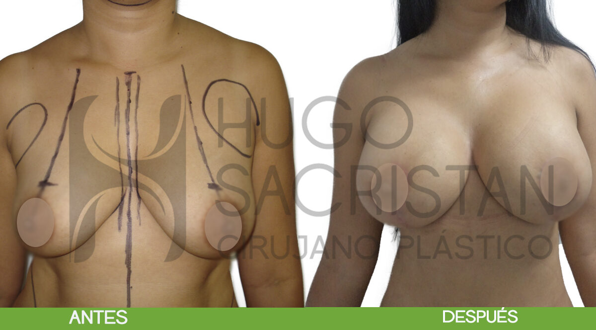 pexia con implantes
