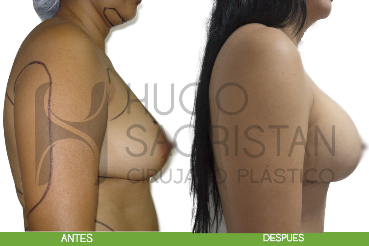pexia con implantes