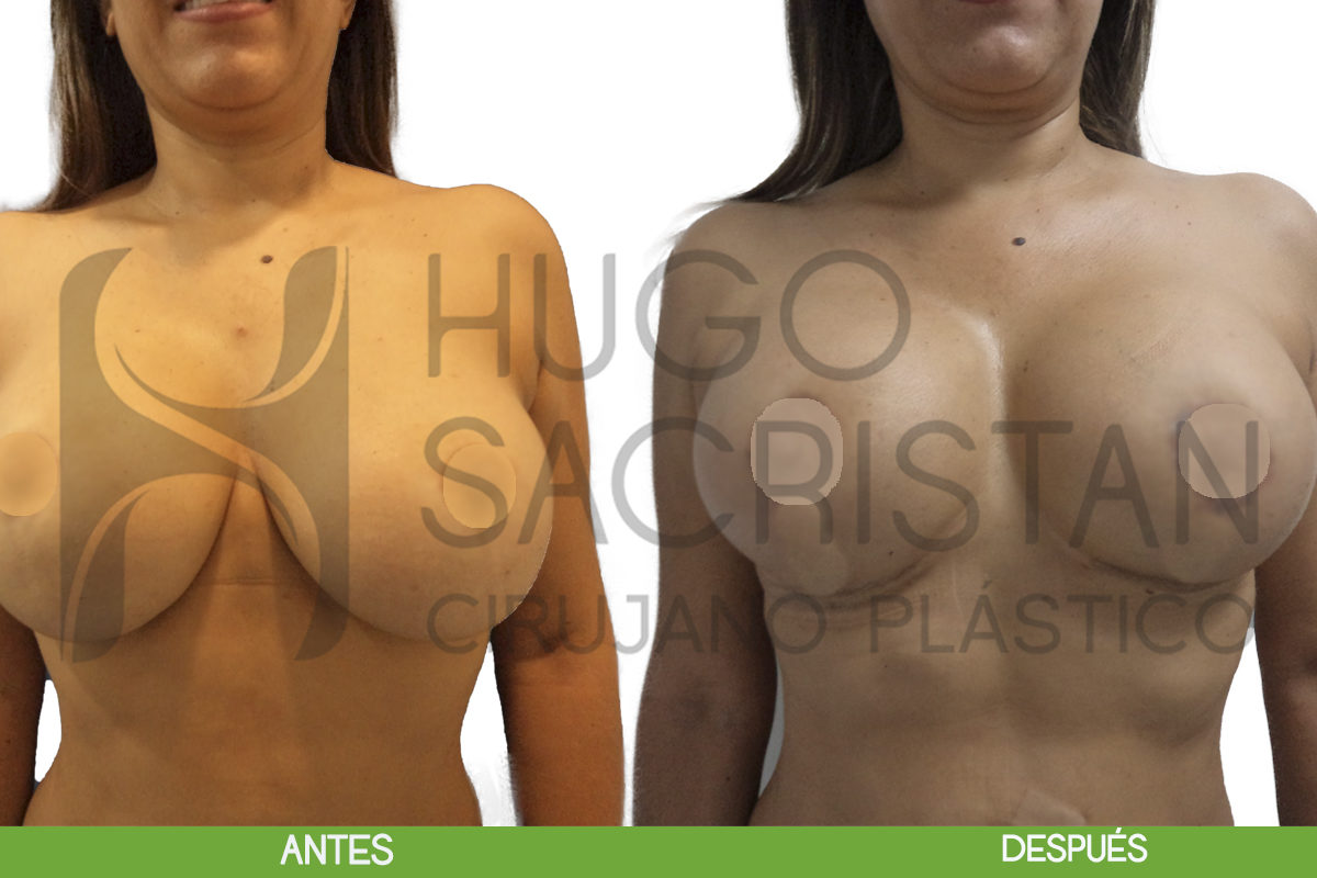 pexia con implantes